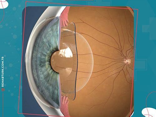Corrective lens implantation