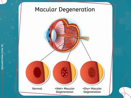 Macular degeneration treatment in Türkiye