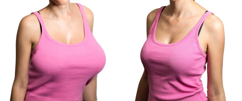 What is Breast Reduction Surgery?