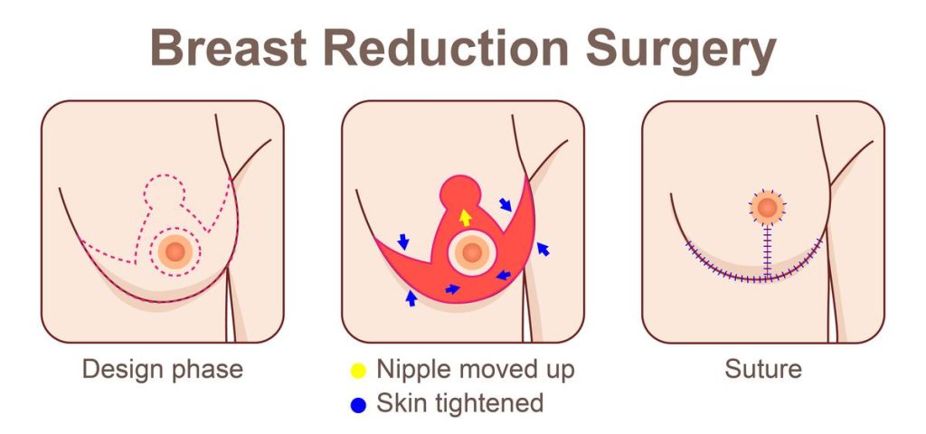 What is Breast Reduction Surgery?