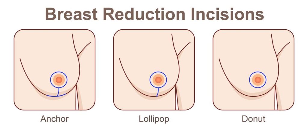 What is Breast Reduction Surgery?