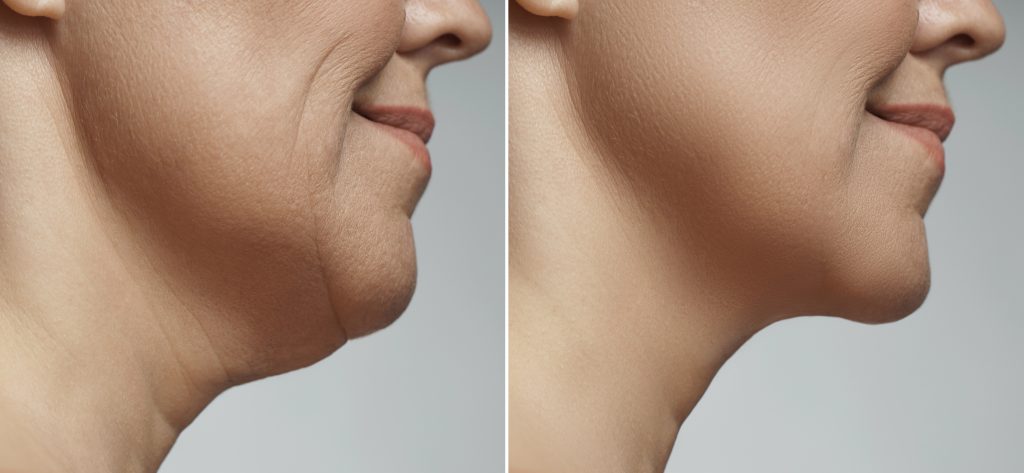 Platysmaplasty (Neck lift)