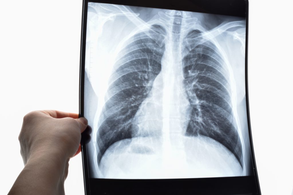 What Is a Lobectomy?