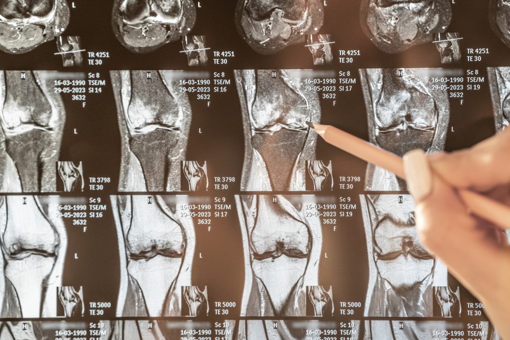 Osteomyelitis