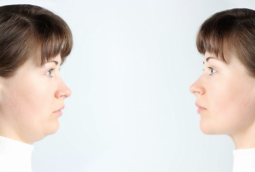 What Is Facial Contouring Surgery?