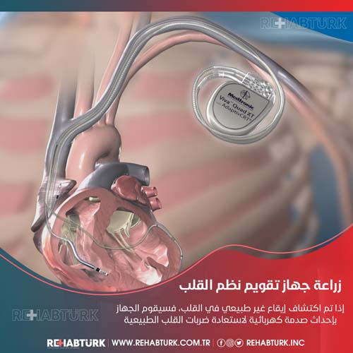 Имплантация кардиоверсии и дефибрилляции в Турции