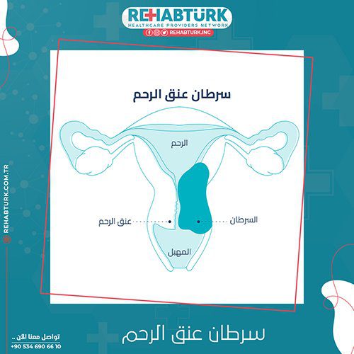 Лечение рака шейки матки в Турции