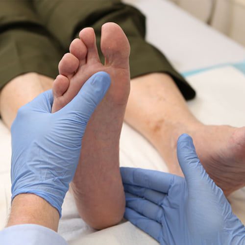 Лечение молоткообразного пальца стопы в Турции