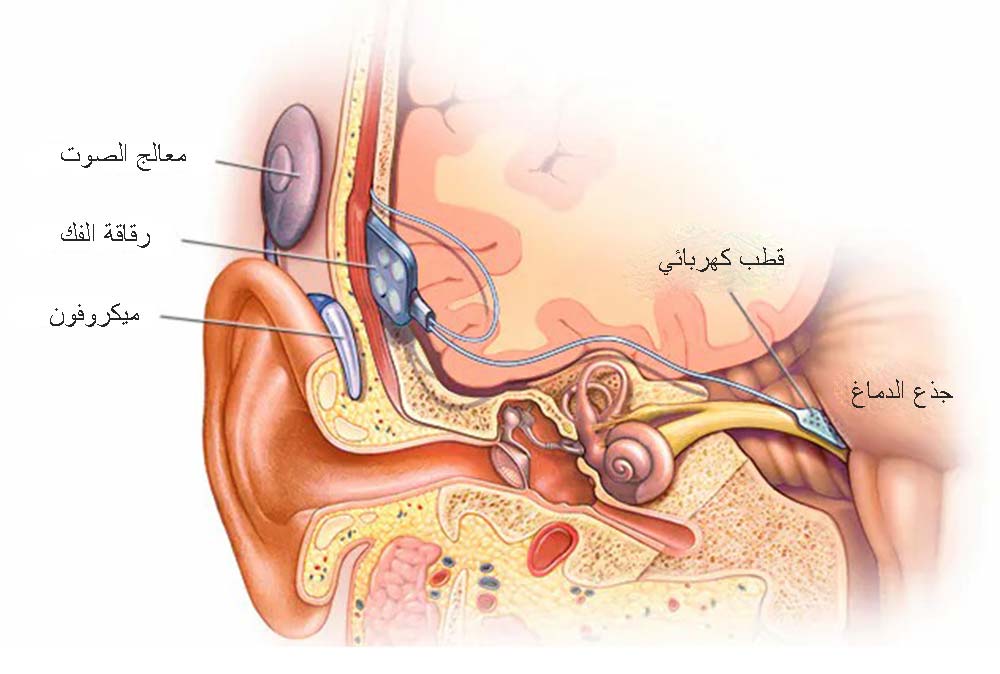 Слуховая трансплантация ствола мозга в Турции