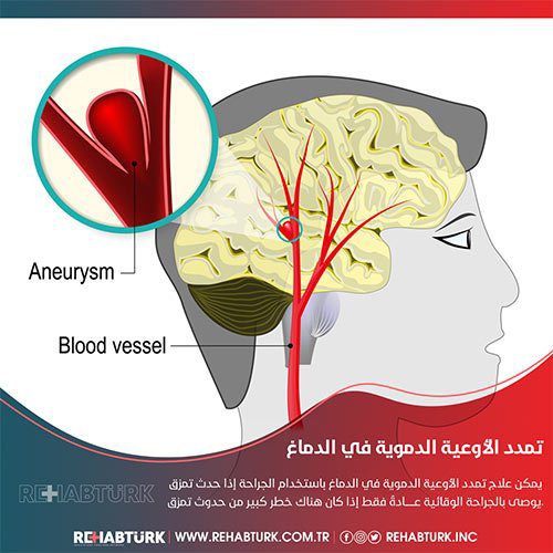 علاج تمدد الأوعية الدموية في الدماغ في تركيا