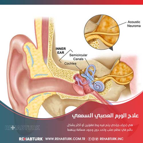 علاج الورم العصبي السمعي في تركيا