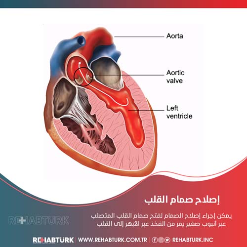 عملية إصلاح صمام القلب في تركيا