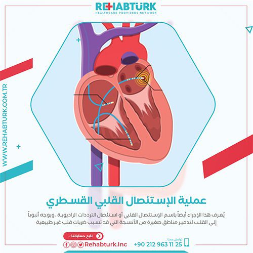 عملية الاستئصال القلبي القسطري في تركيا