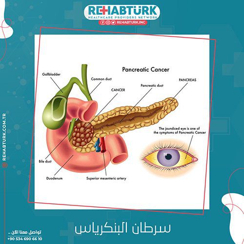 علاج سرطان البنكرياس في تركيا