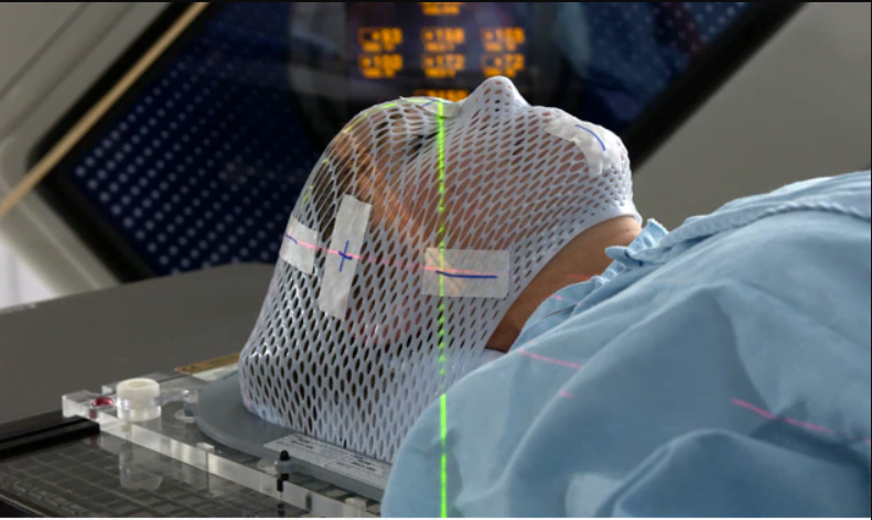 الجراحة الإشعاعية بالتوضيع التجسيمي