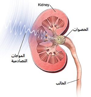 cross section of kidney showing shock waves