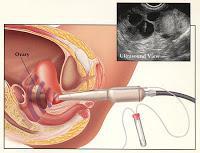 transvaginal ultrasound guided oocyte