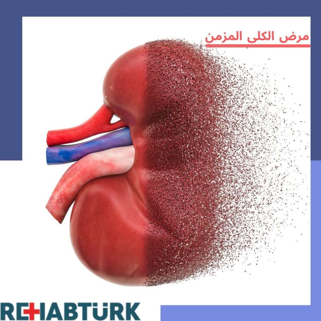 مرض الكلى المزمن