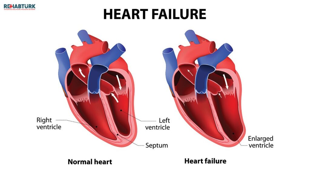 علاج قصور القلب حسب المرحلة