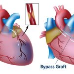 Befor and After Coronary Artery Bypass Grafting 1024x582 1