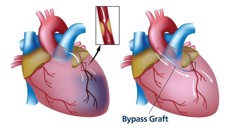 Befor and After Coronary Artery Bypass Grafting 1024x582 1