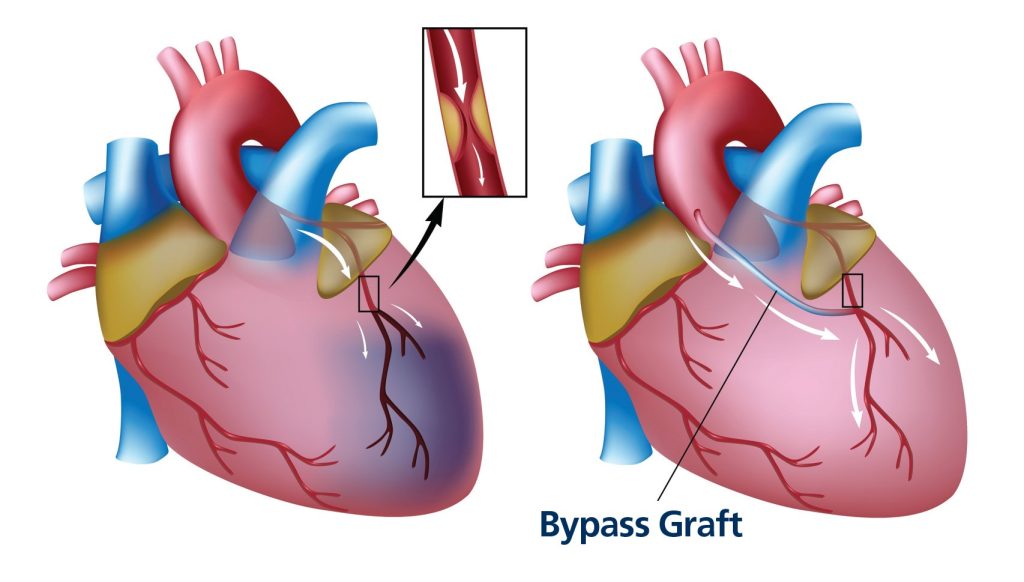 Befor and After Coronary Artery Bypass Grafting
