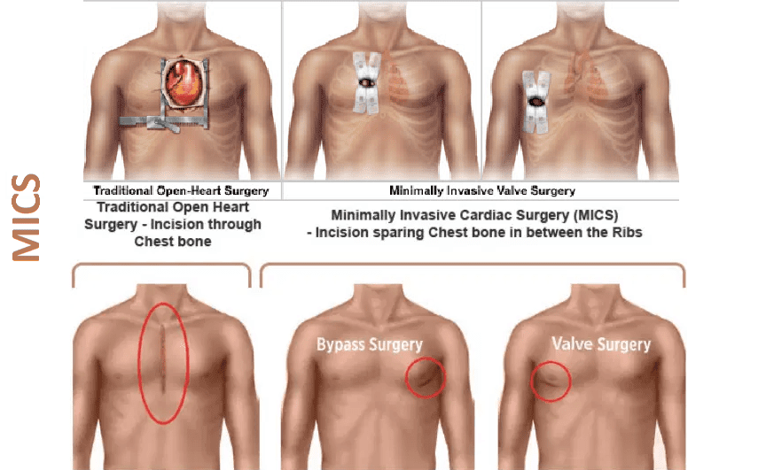 عملية القلب المفتوح، طريقة الإجراء  والمخاطر المحتملة في تركيا