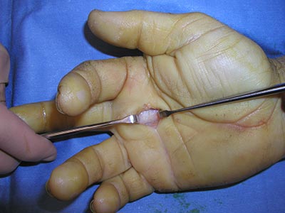 علاج الإصبع الزنادي الجراحي وبدون جراحة في تركيا