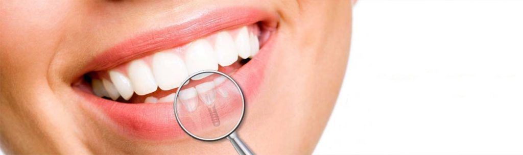 هل تبدو زراعة الأسنان مثل الأسنان الطبيعية؟