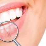 هل تبدو زراعة الأسنان مثل الأسنان الطبيعية؟