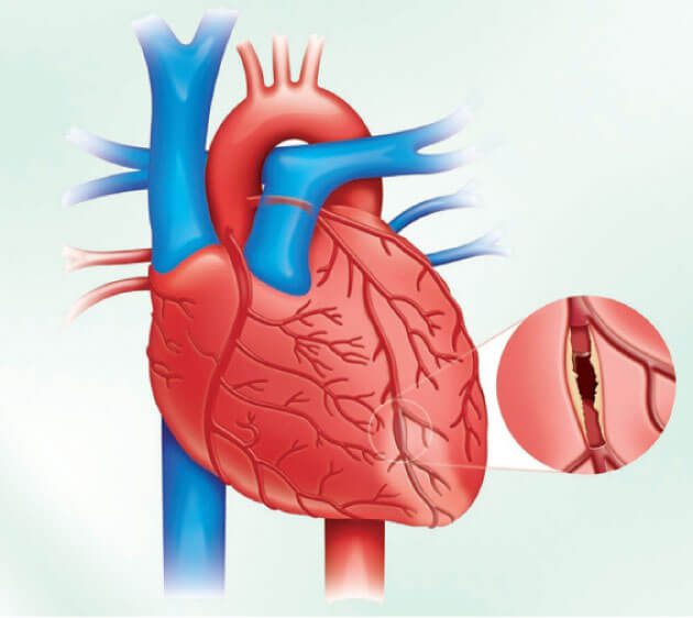 القسطرة القلبية والدعامات