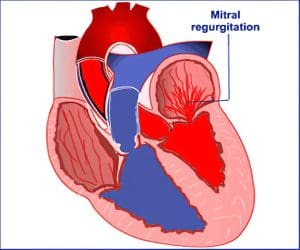 3 طرق لعلاج القلس المترالي