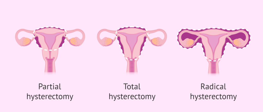 ما هو عملية استئصال الرحم عند المرأة 2022