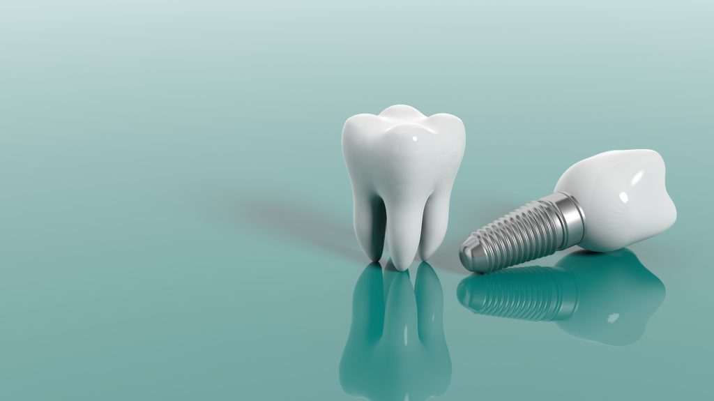 علاج زراعة الأسنان 2022