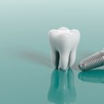 علاج زراعة الأسنان 2022
