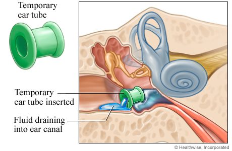 عملية انبوب الأذن لتخفيف الضغط الواقع عليها