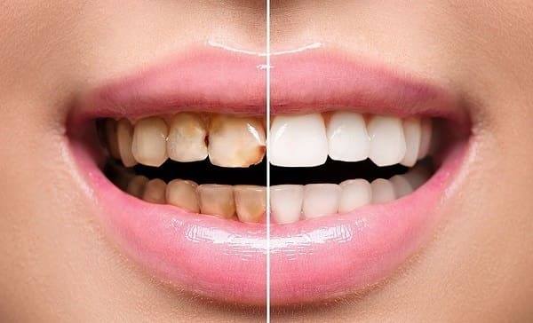 ترميم الاسنان افضل الحلول لك