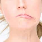 شلل الوجه النصفي التشخيص والعلاج
