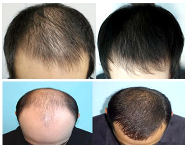 علاج الشعر بالليزر و علاج تساقط الشعر