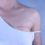 استئصال كتلة الثدي و طرق العلاج