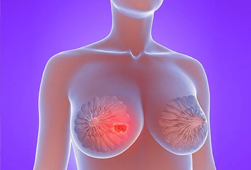 استئصال كتلة الثدي و طرق العلاج