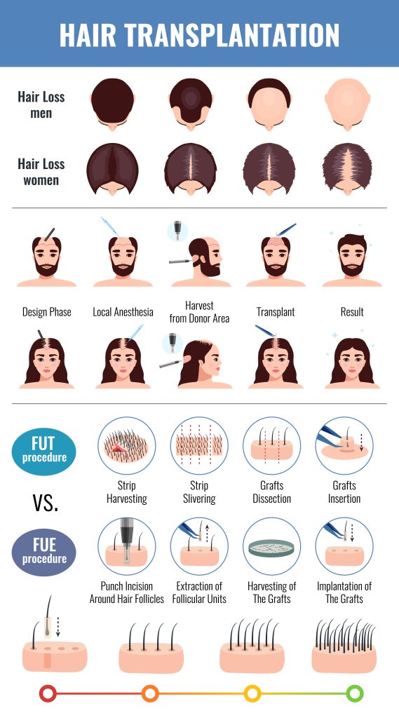 أنواع جراحات زراعة الشعر