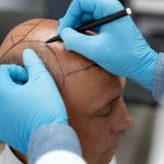 أنواع جراحات زراعة الشعر