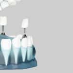 ما هي زراعة الأسنان في يوم واحد؟