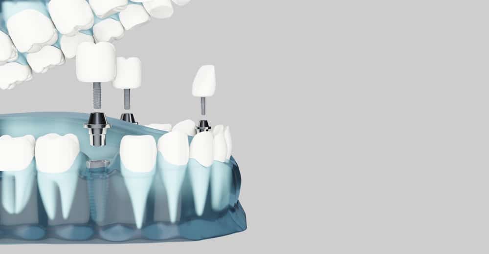 ما هي زراعة الأسنان في يوم واحد؟