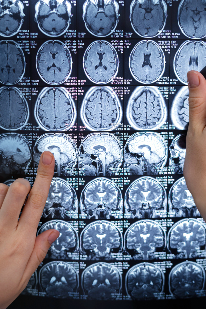 جراحة ورم الدماغ العميق | ما هي أفضل طرق العلاج؟