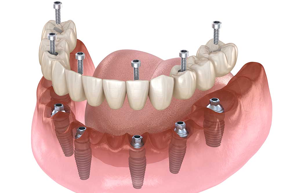 ما هي عملية زراعة الأسنان الكل في ستة؟