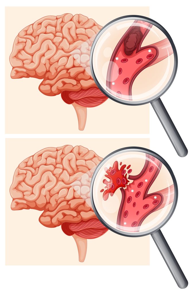 أورام الدماغ الدموية | العلاج والوقاية