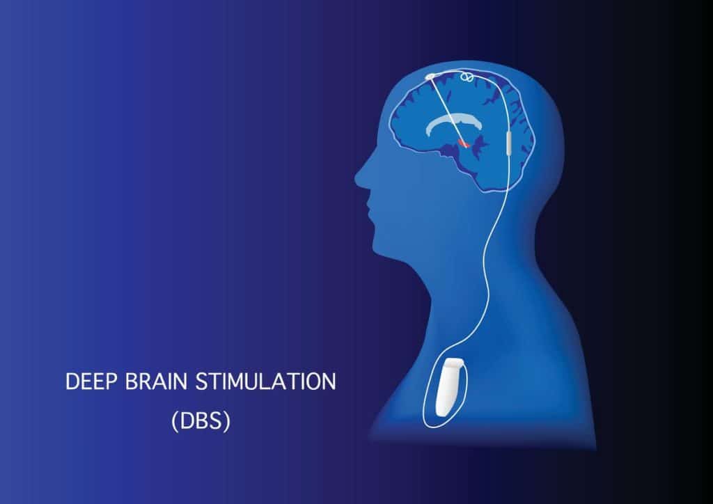 ما هو التحفيز العميق للدماغ (DBS)؟
