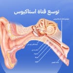 انسداد قناة استاكيوس